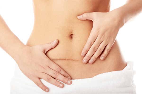 Everything You Need To Know About C-Section Scars