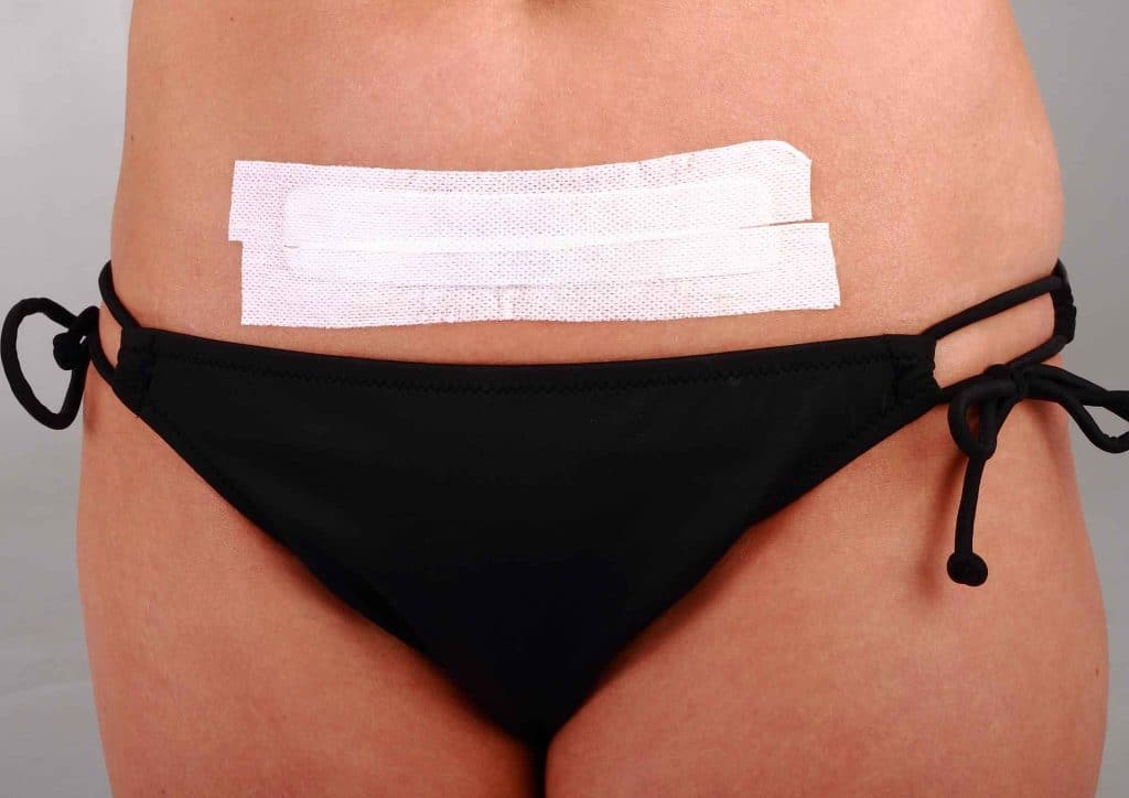 Everything You Need To Know About C-Section Scars