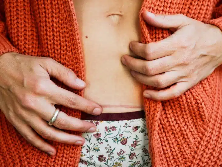 Everything You Need To Know About C-Section Scars