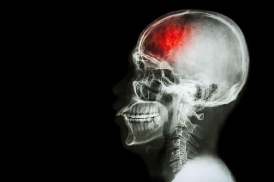 Early Warning Signs Of Stroke You Should Never Ignore