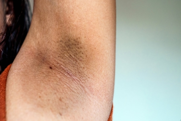 Weird Skin Changes That Might Point to Serious Issues